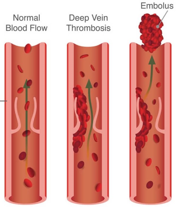 Тромбоз артерия и вена. Обтурирующий тромб вены. Пристеночный тромб в сосуде.